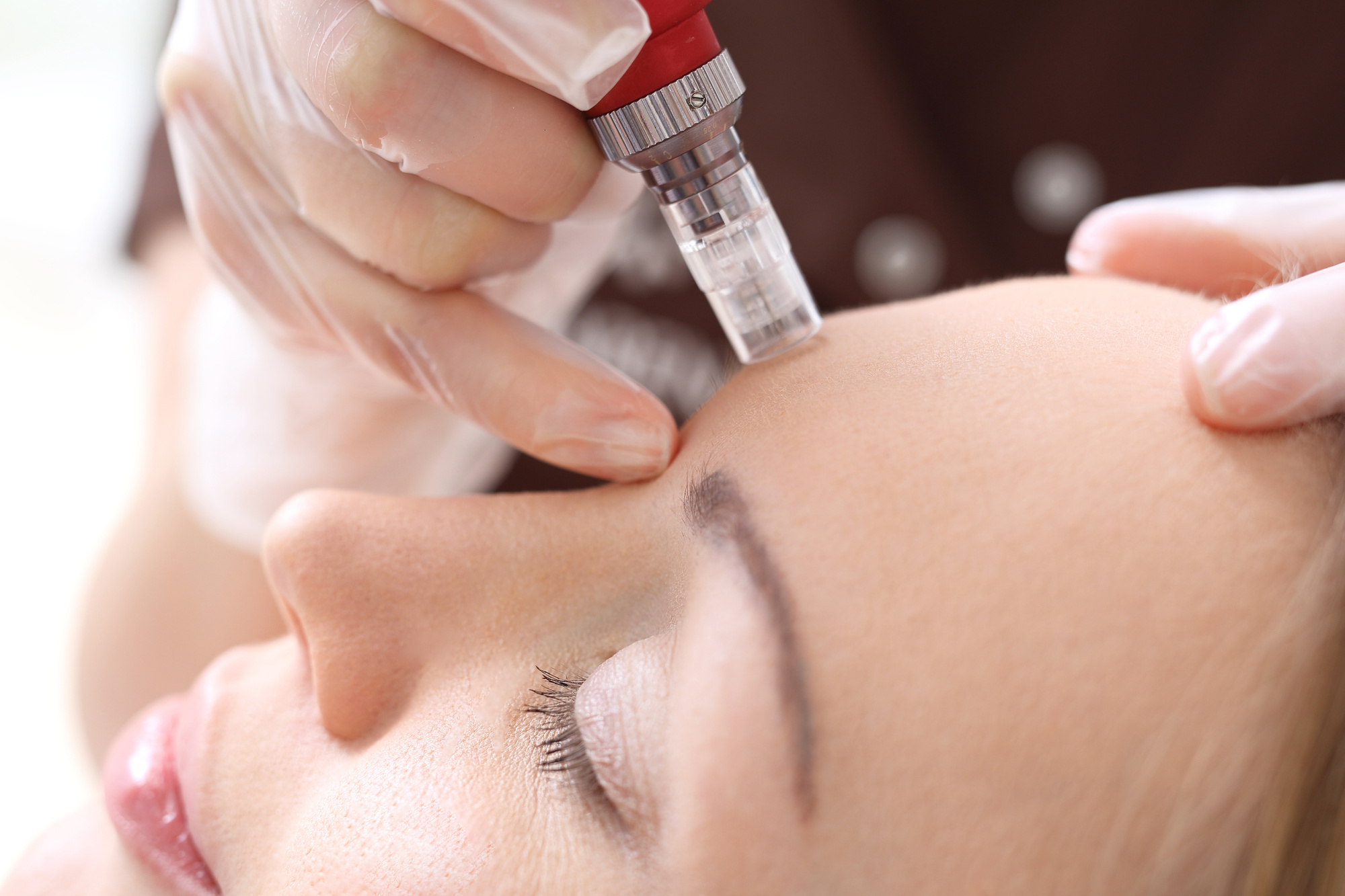Microneedling , Kosmetik Murnau, Cosmetics, Apparative Cosmetics , facial treatment, Jet Peel, Microneedling , Hydra Facial, Medical Beauty